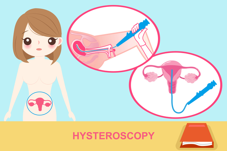 Isteroscopia diagnostica Roma, a chi rivolgersi?