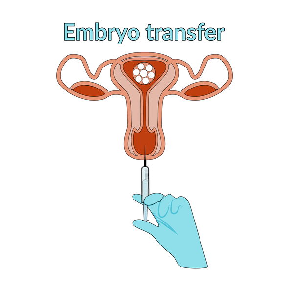 Trasferimento embrione in utero: tempi, sintomi, indicazioni