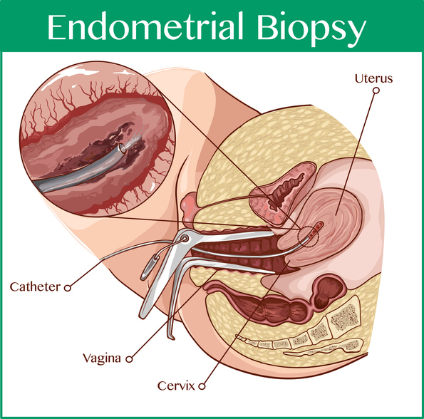 Endometriocoltura prima della PMA: perché si fa e a cosa serve