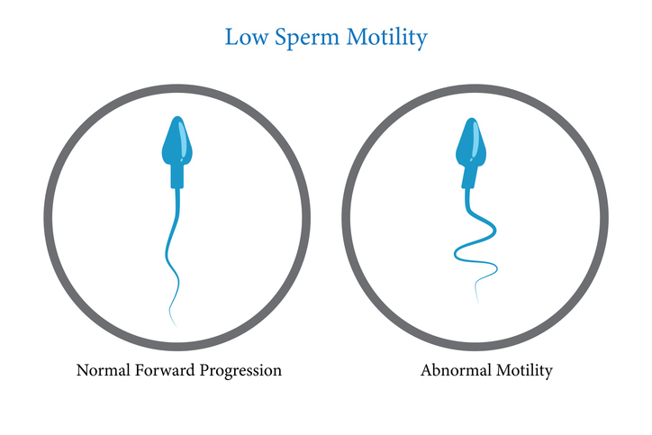 Motilità spermiogramma bassa rimedi, consigli da un esperto