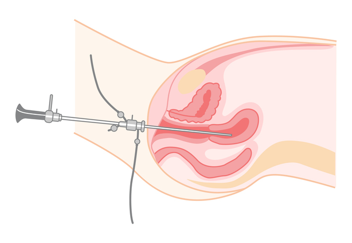 Isteroscopia testimonianze