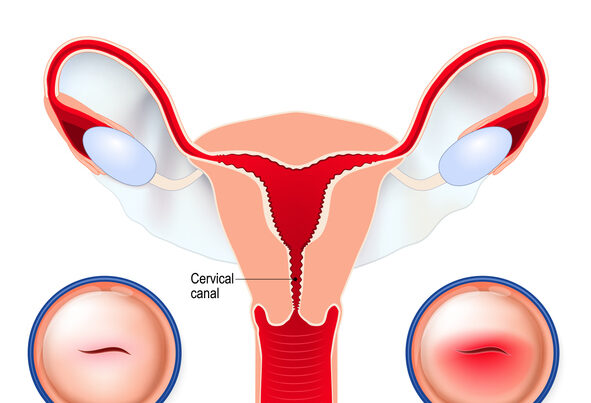 Ectropion utero: cos’è e come si cura