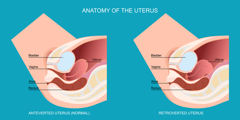 Utero retroflesso: cos’è, cosa comporta, quali rischi per la gravidanza