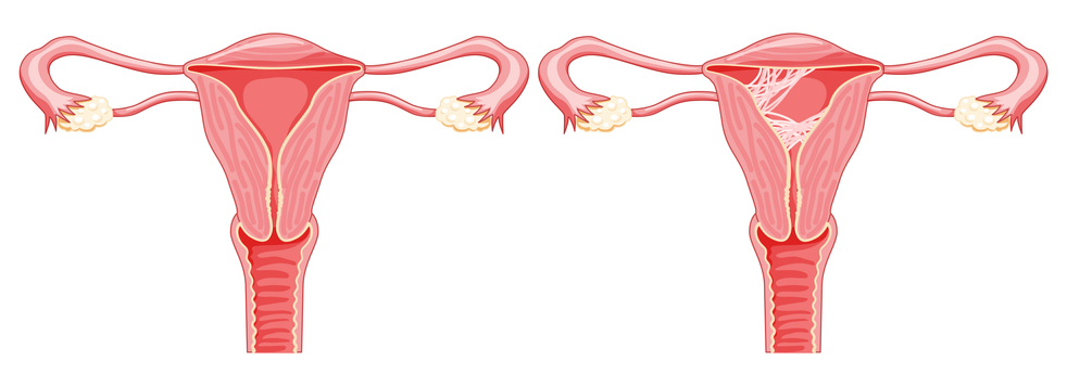 Aderenze utero: cause, sintomi e cure