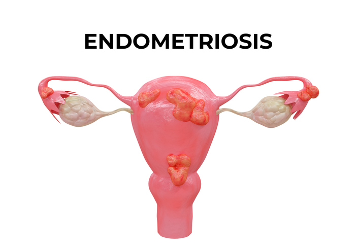 Endometriosi e gravidanza naturale è possibile?