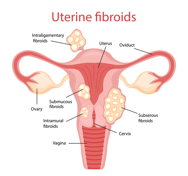 Fibroma in gravidanza: rischi e trattamenti