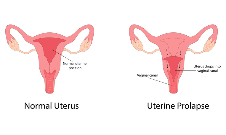 Prolasso uterino sintomi, trattamenti e cure